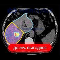 Медицинское программное обеспечение MIM SurePlan™ LiverY90